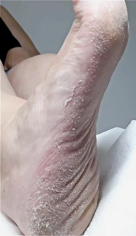 כף רגל סוכרתית עם עור יבש, סדוק ומעובה לפני טיפול פדיקור רפואי מונע