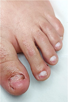 שיקום הציפורן ושחרור הלחץ החודרני לאחר טיפול מקצועי בעקבות פציעה או מכה