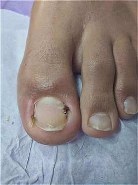 ציפורן חודרנית עם דלקת חריפה וכאב פועם לפני טיפול פדיקור רפואי