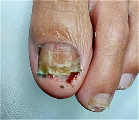 שילוב של פטרת ציפורניים וציפורן חודרנית מודלקת לפני טיפול פדיקור רפואי משולב