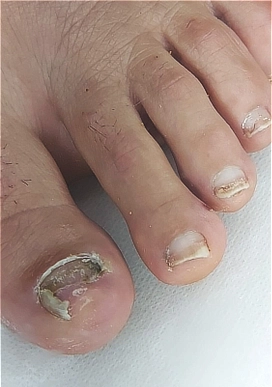 ציפורן לאחר טראומה ומכה המפתחת מצב של ציפורן חודרנית לפני טיפול פדיקור רפואי