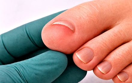 שיקום ושחזור ציפורן